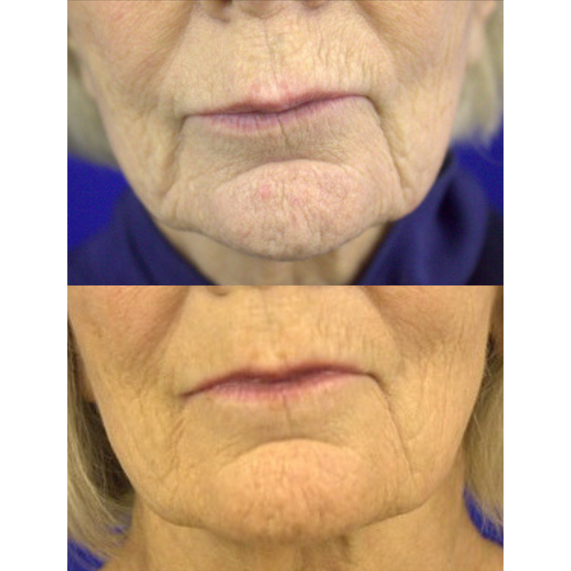 Neurotoxin before and after of a woman's chin