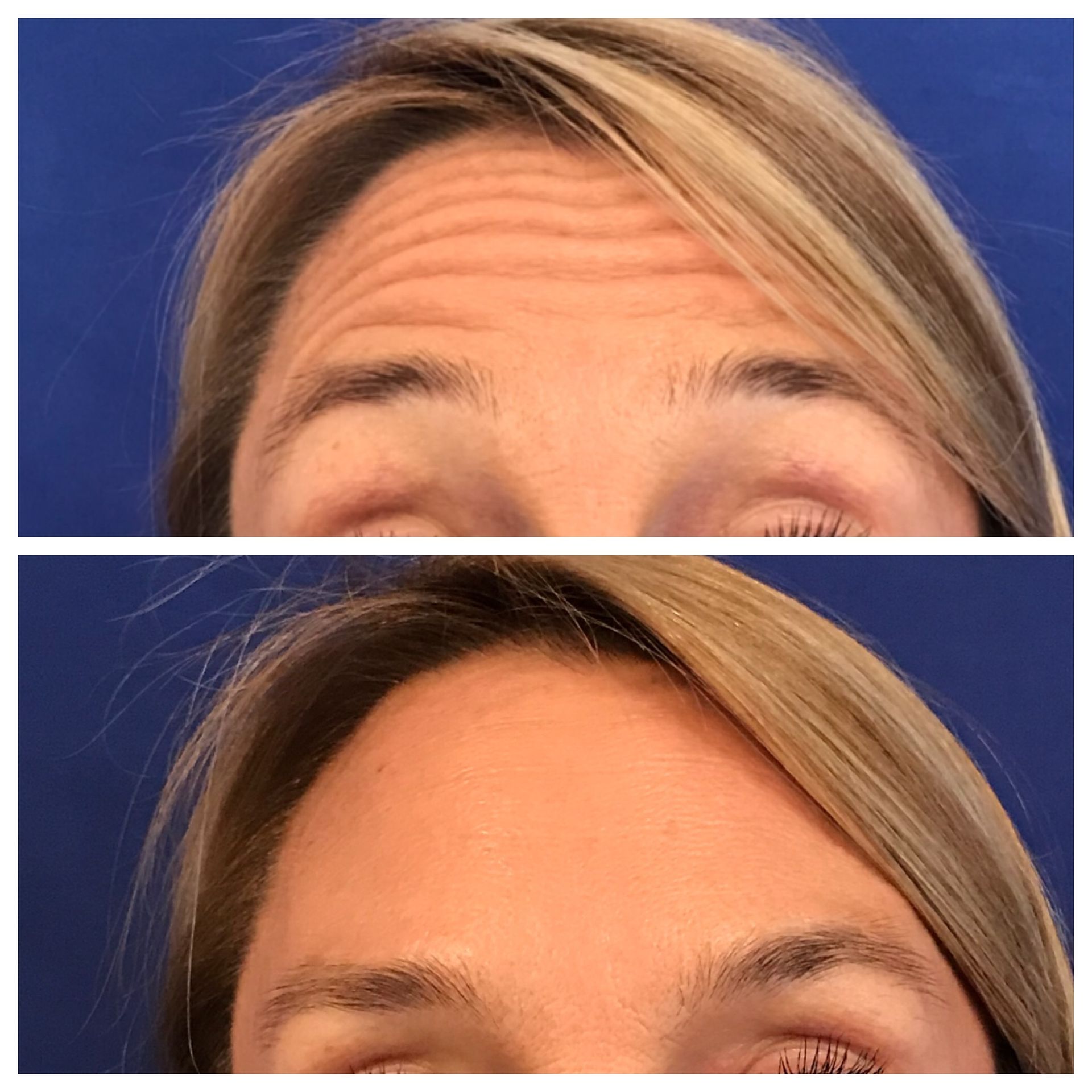 Neurotoxin before and after of a woman's forehead