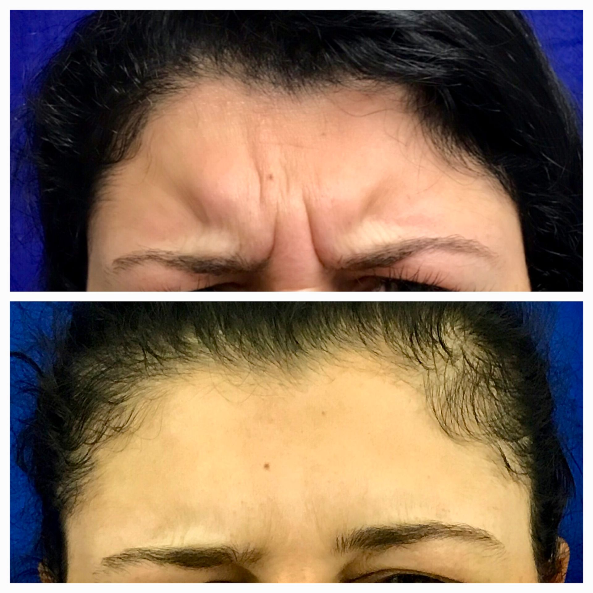Neurotoxin before and after of a woman's forehead