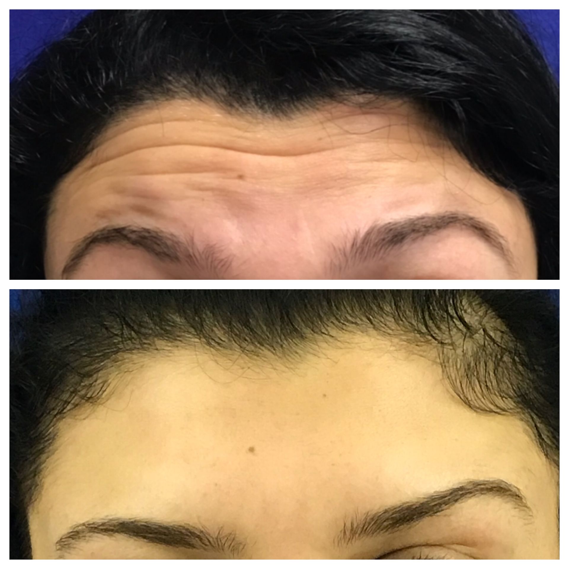 Neurotoxin before and after of a woman's forehead