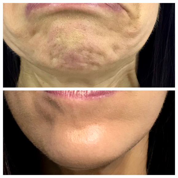 Neurotoxin before and after of a woman's chin