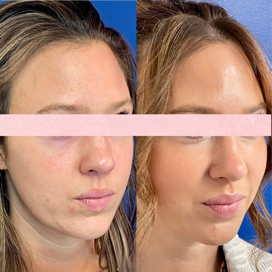 Renuva before and after of a woman's face