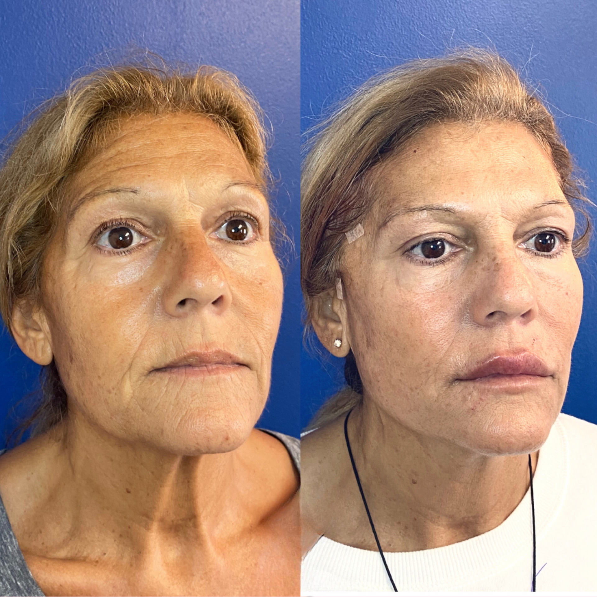 PDO Thread before and after of a woman's face