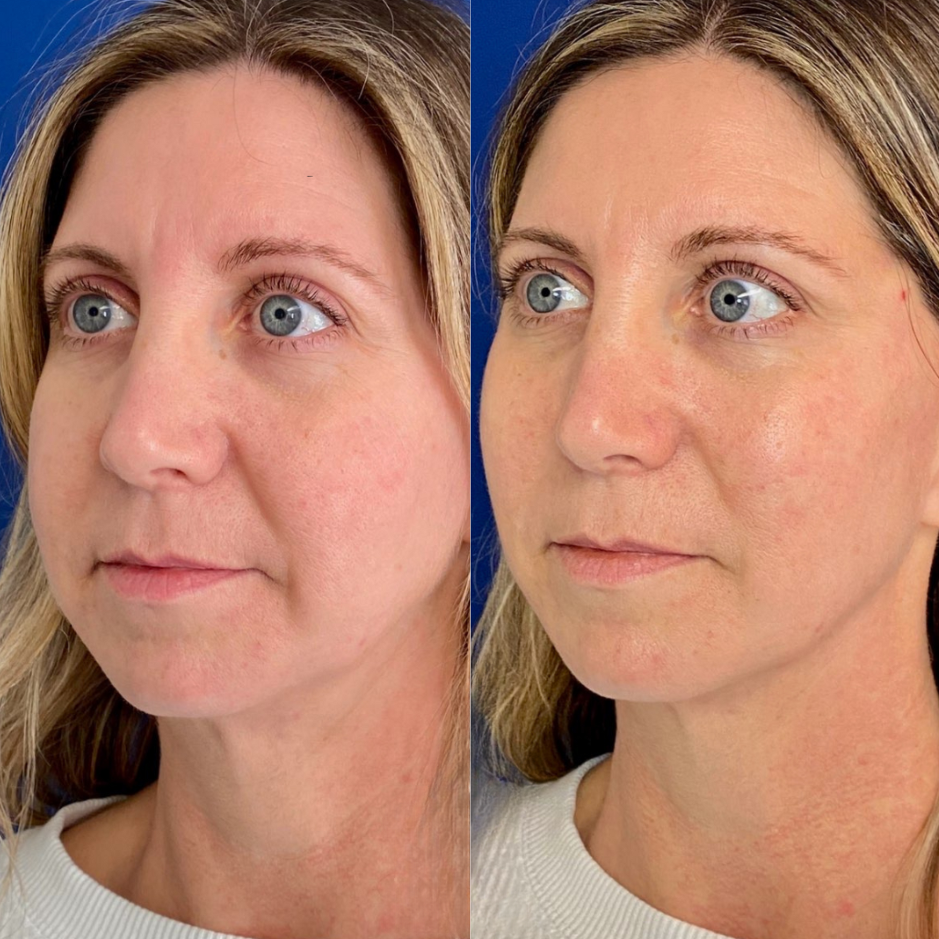 PDO Thread before and after of a woman's face