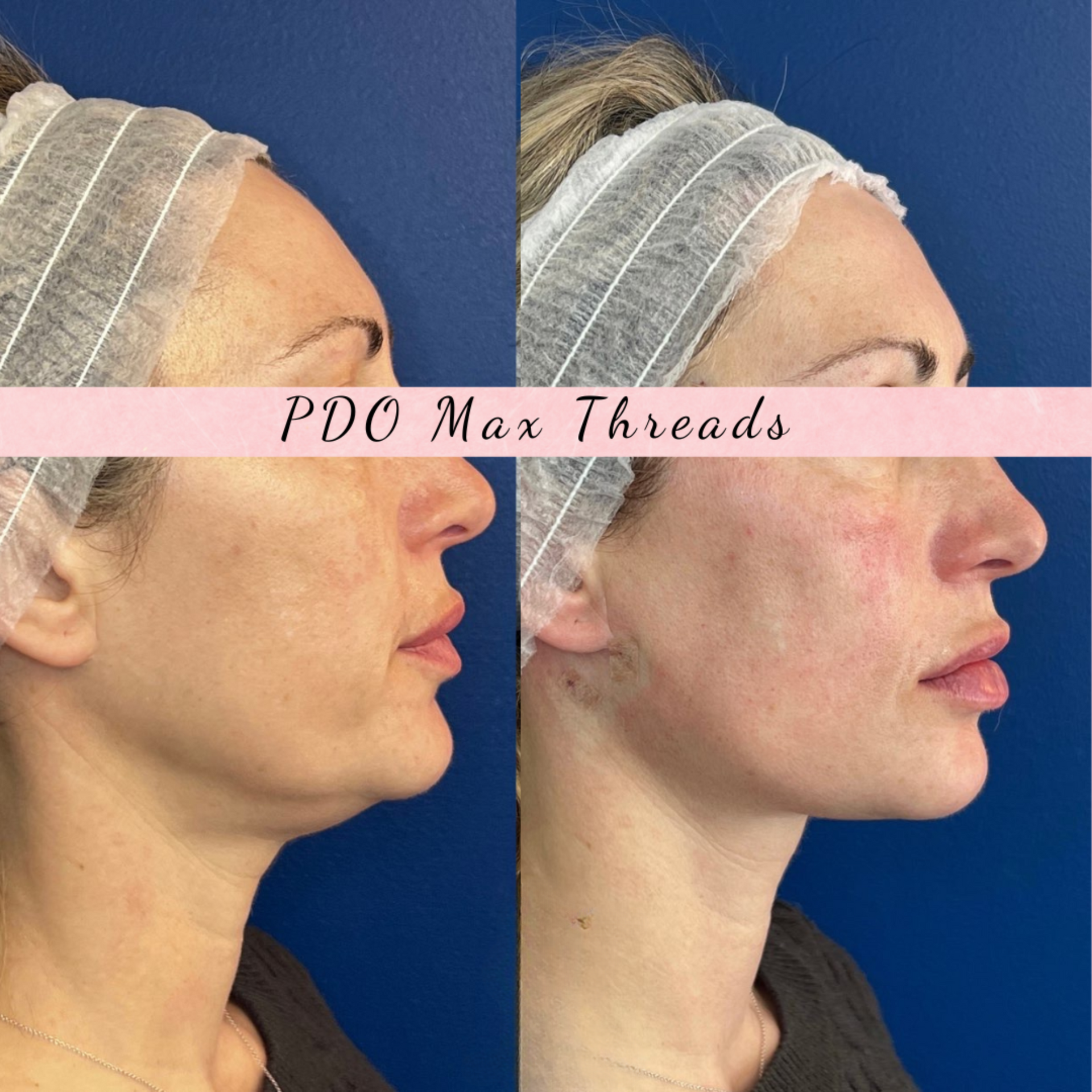 PDO Thread before and after of a woman's jawline