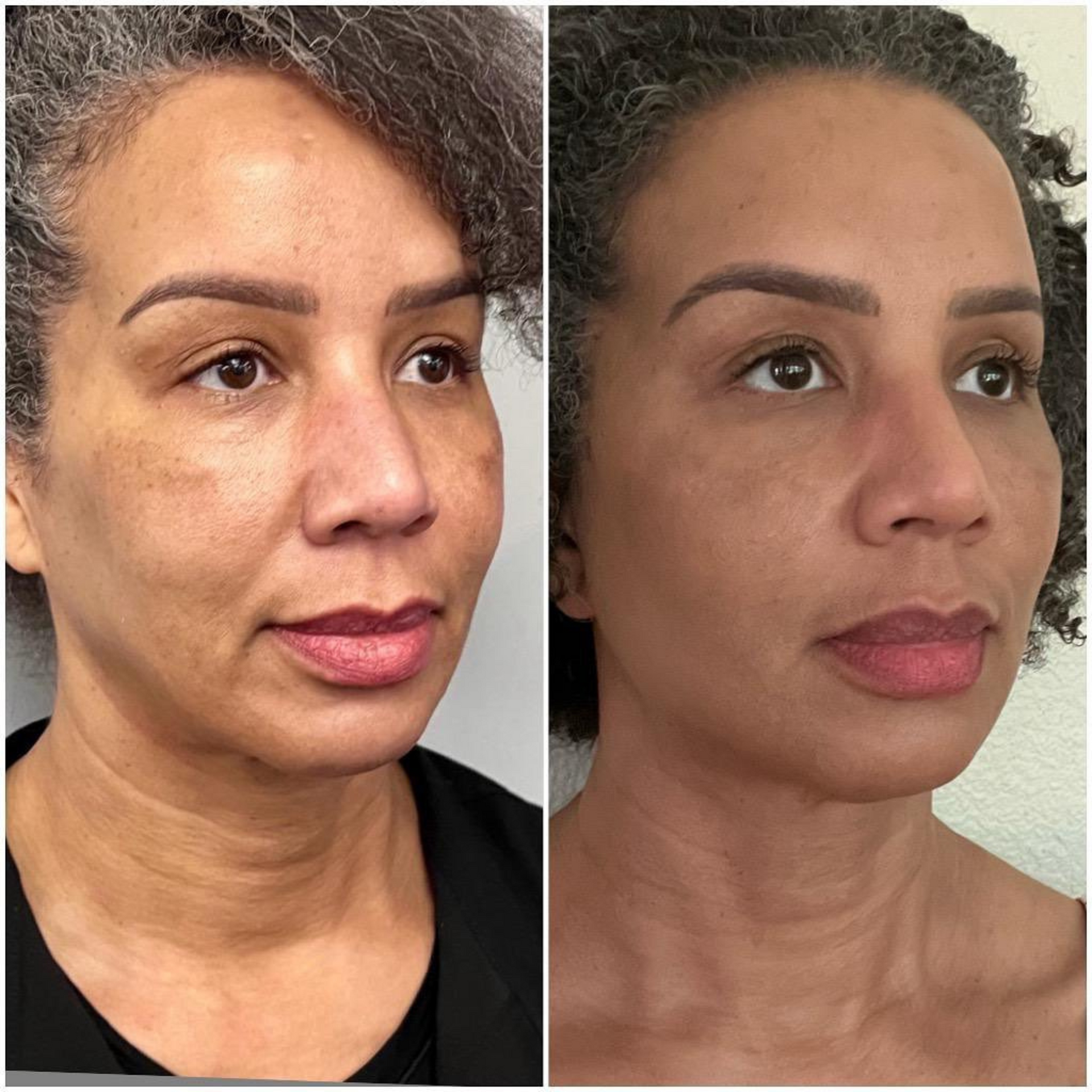 PDO Thread treatment before and after image of a woman