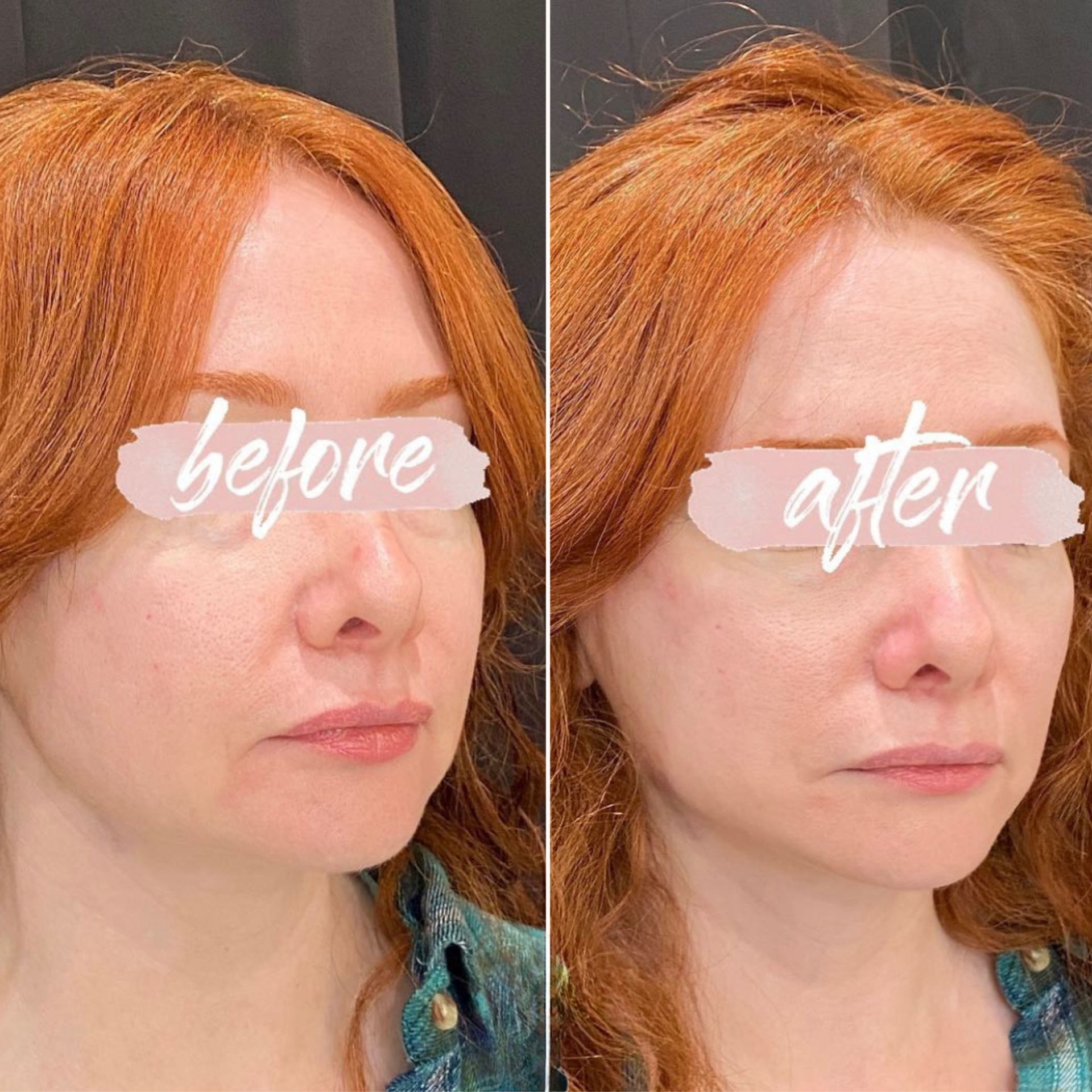 PDO Thread before and after of a woman's face