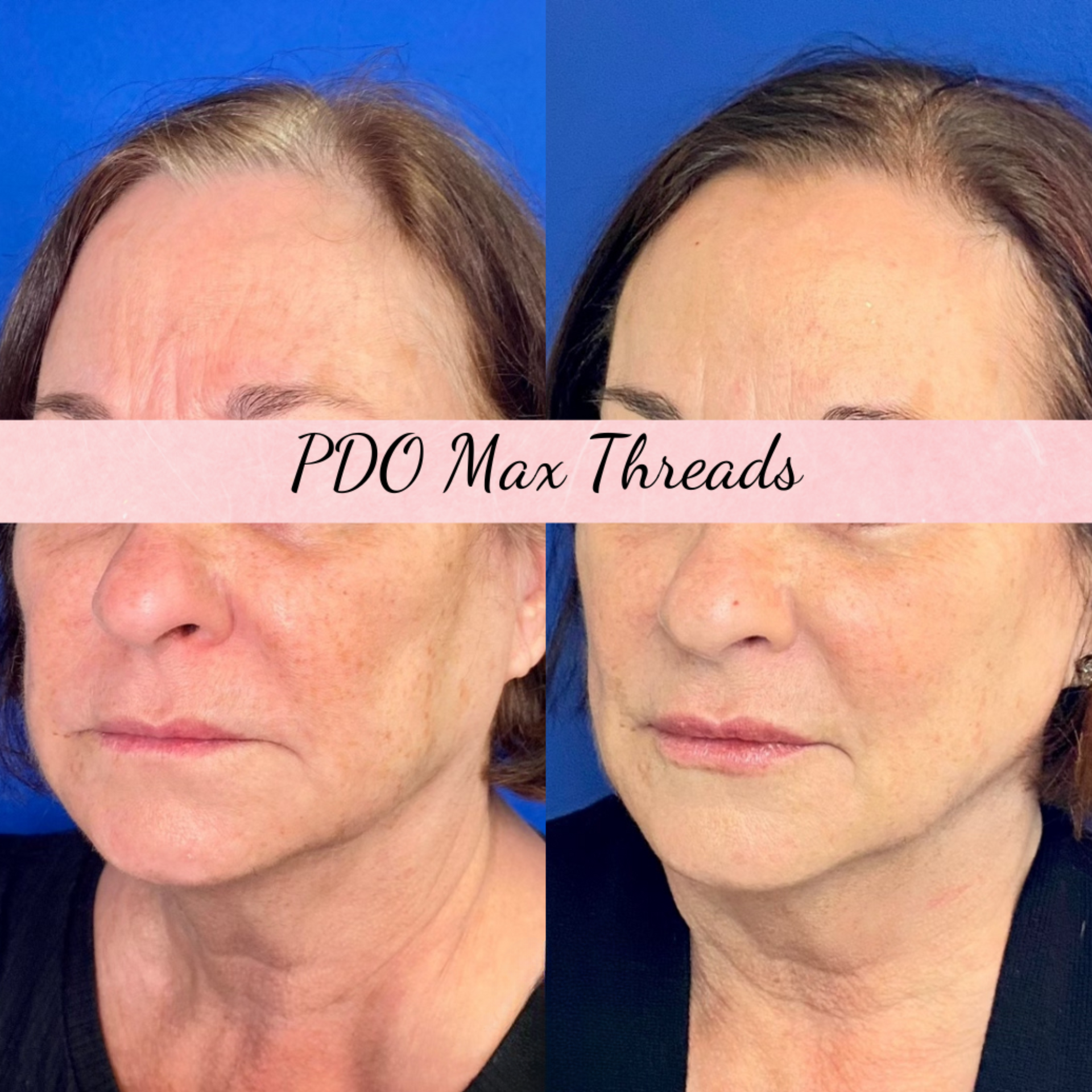 PDO Thread before and after of a woman's face