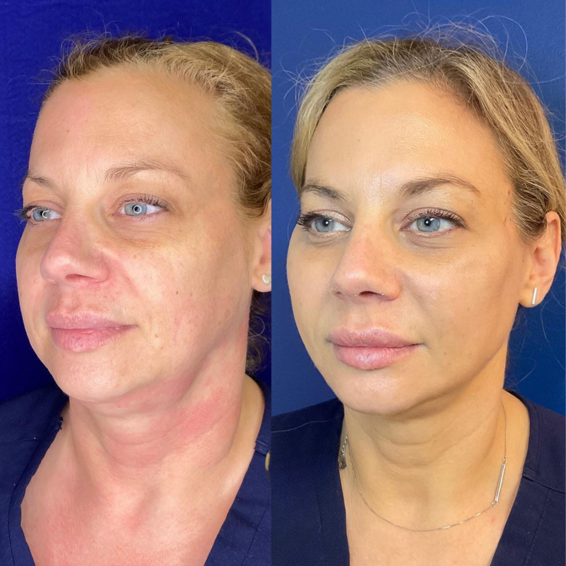PDO Thread treatment before and after image of a woman