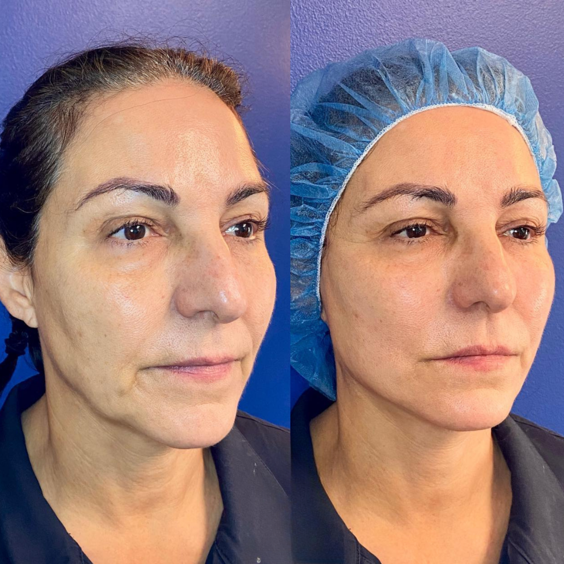 PDO Thread before and after of a woman's face