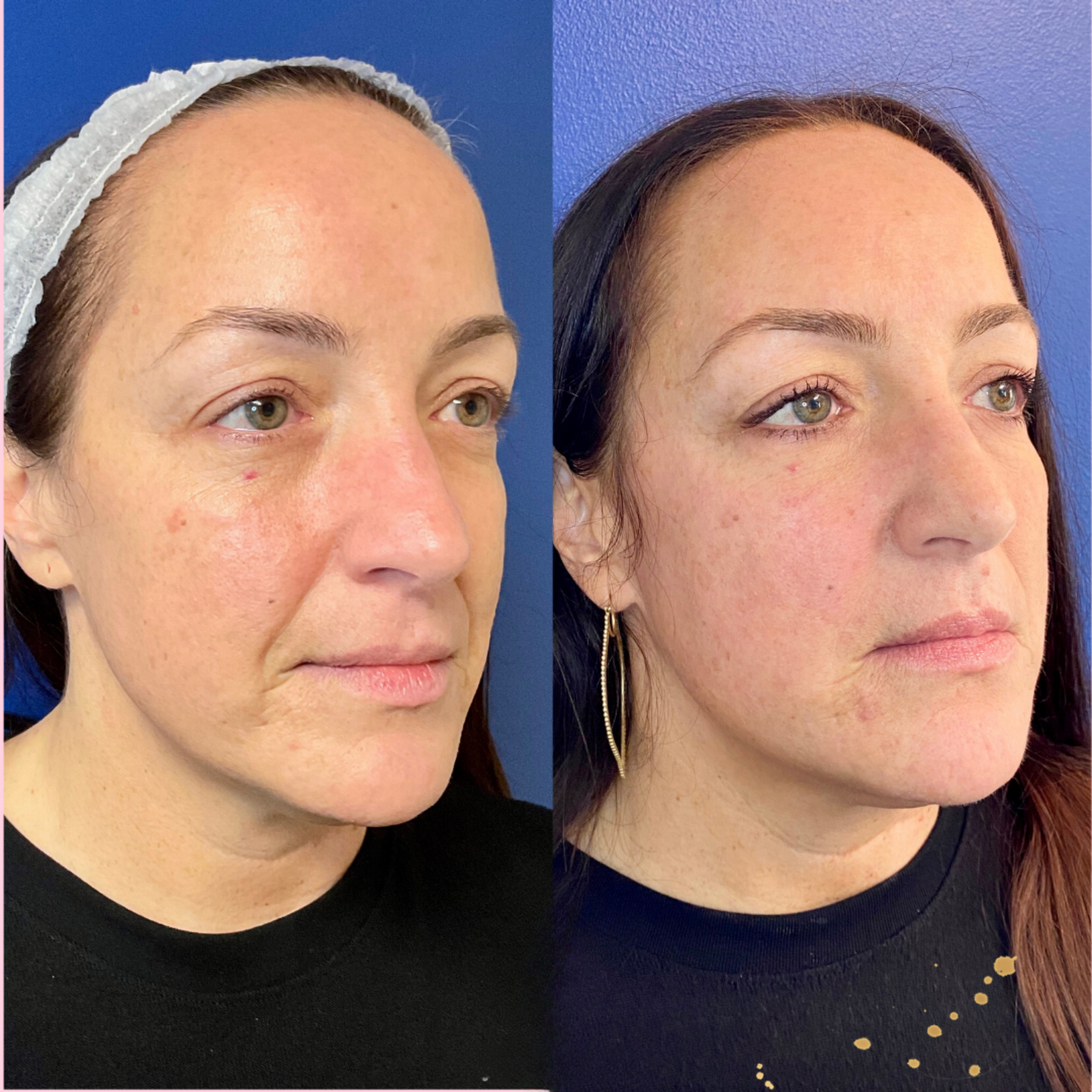 PDO Thread treatment before and after image of a woman