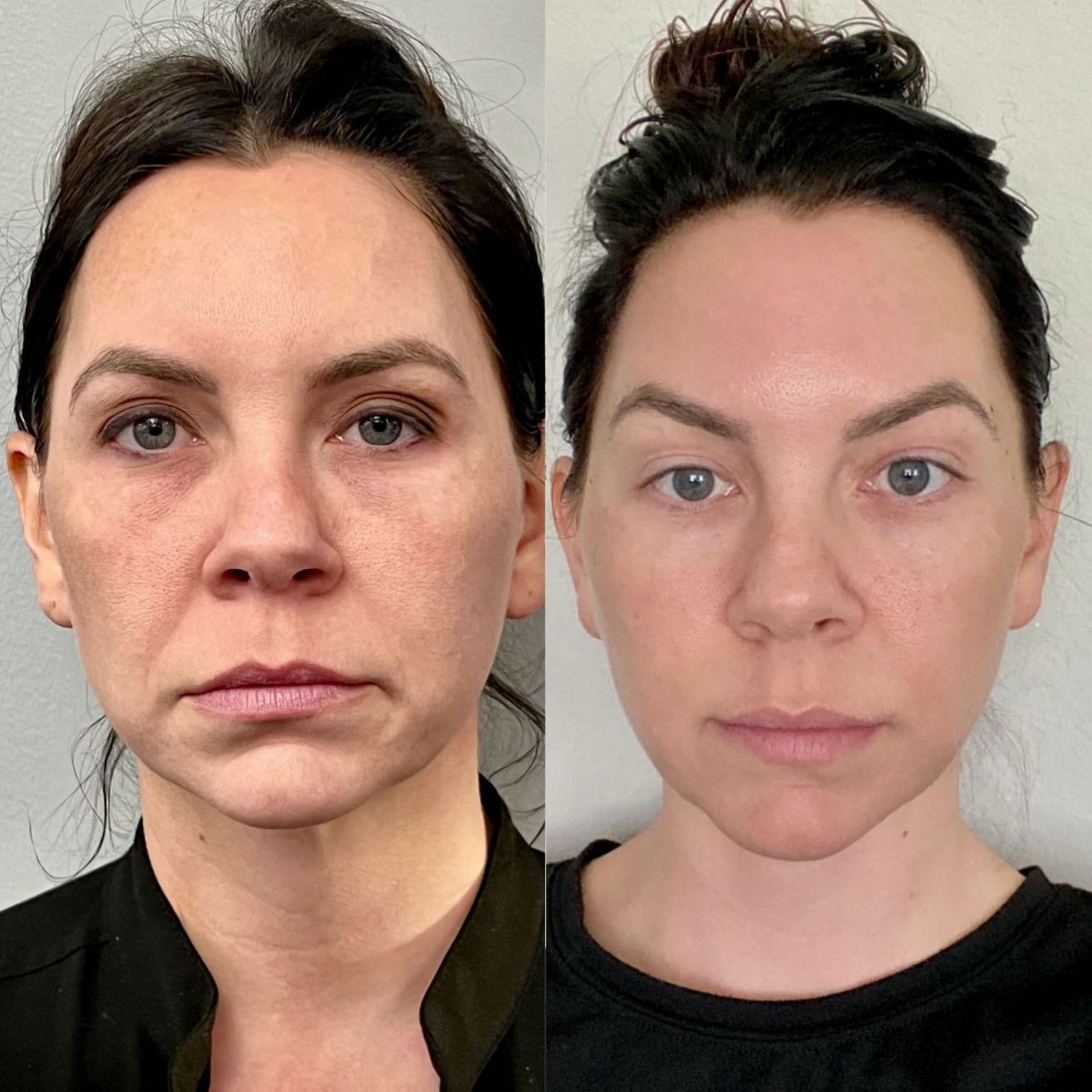 PDO Thread treatment before and after image of a woman