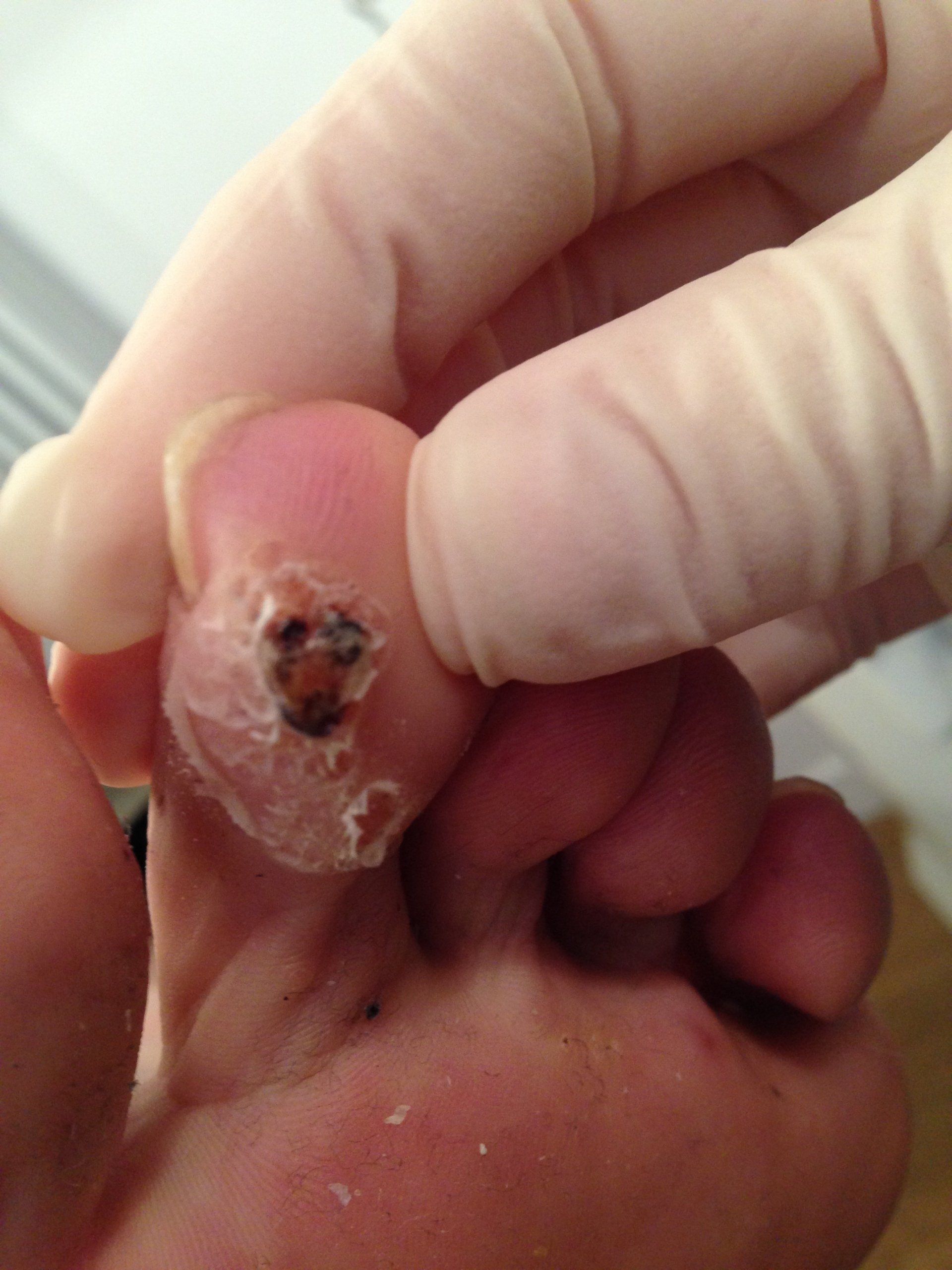 A podiatrist is holding a foot with verrucae prior to treatment at Pod Clinic