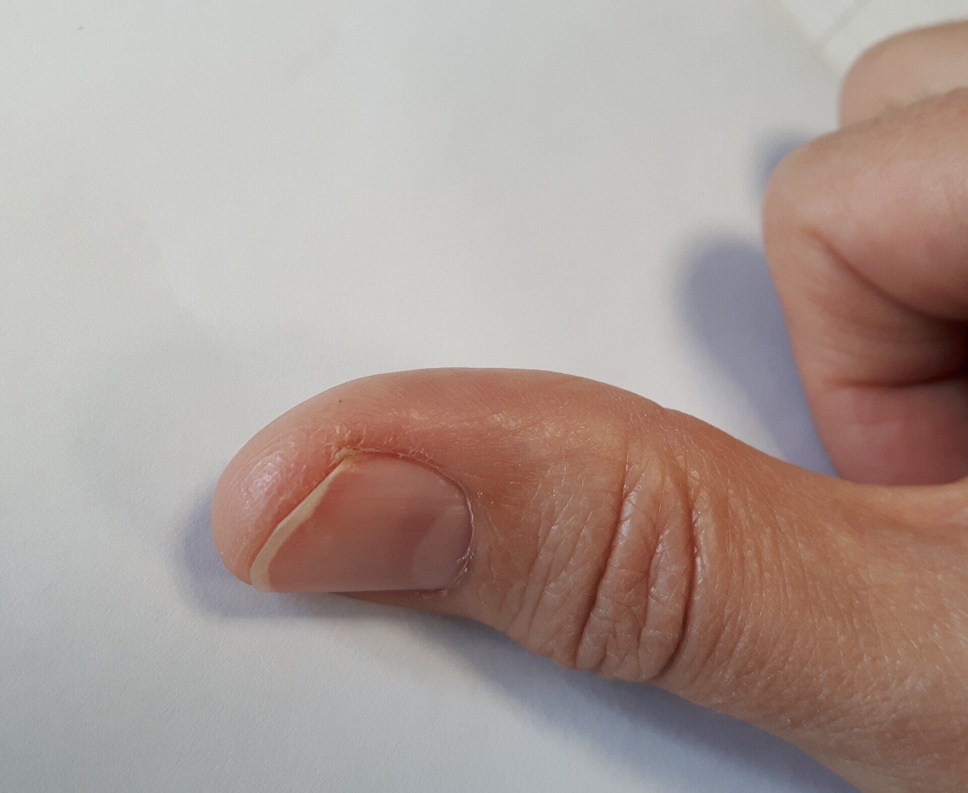 A thumb with a wart after to treatment with Swift microwave at Pod Clinic