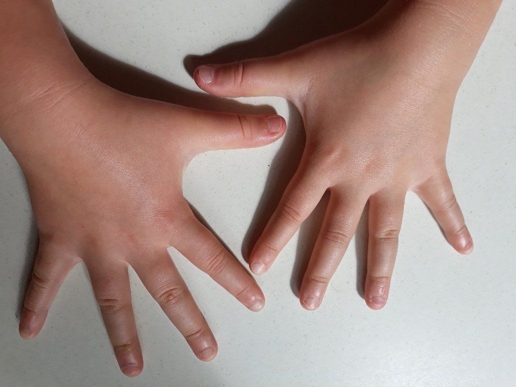 A close up of a child 's hands with warts after treatment at Pod Clinic