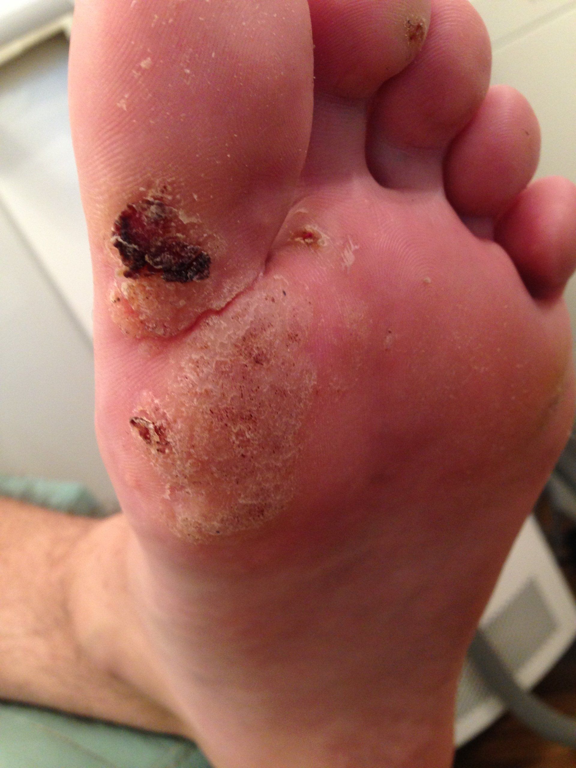 A foot with a wart condition prior to treatment at Pod 