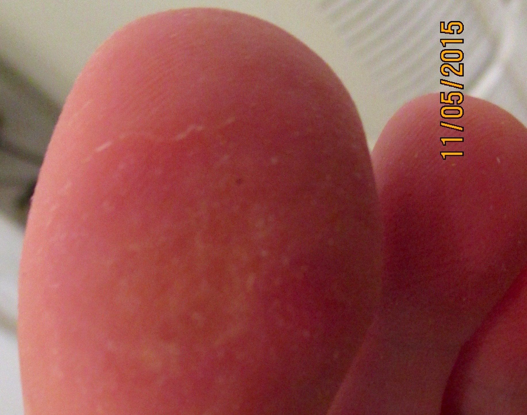 A large toe after treatment for warts