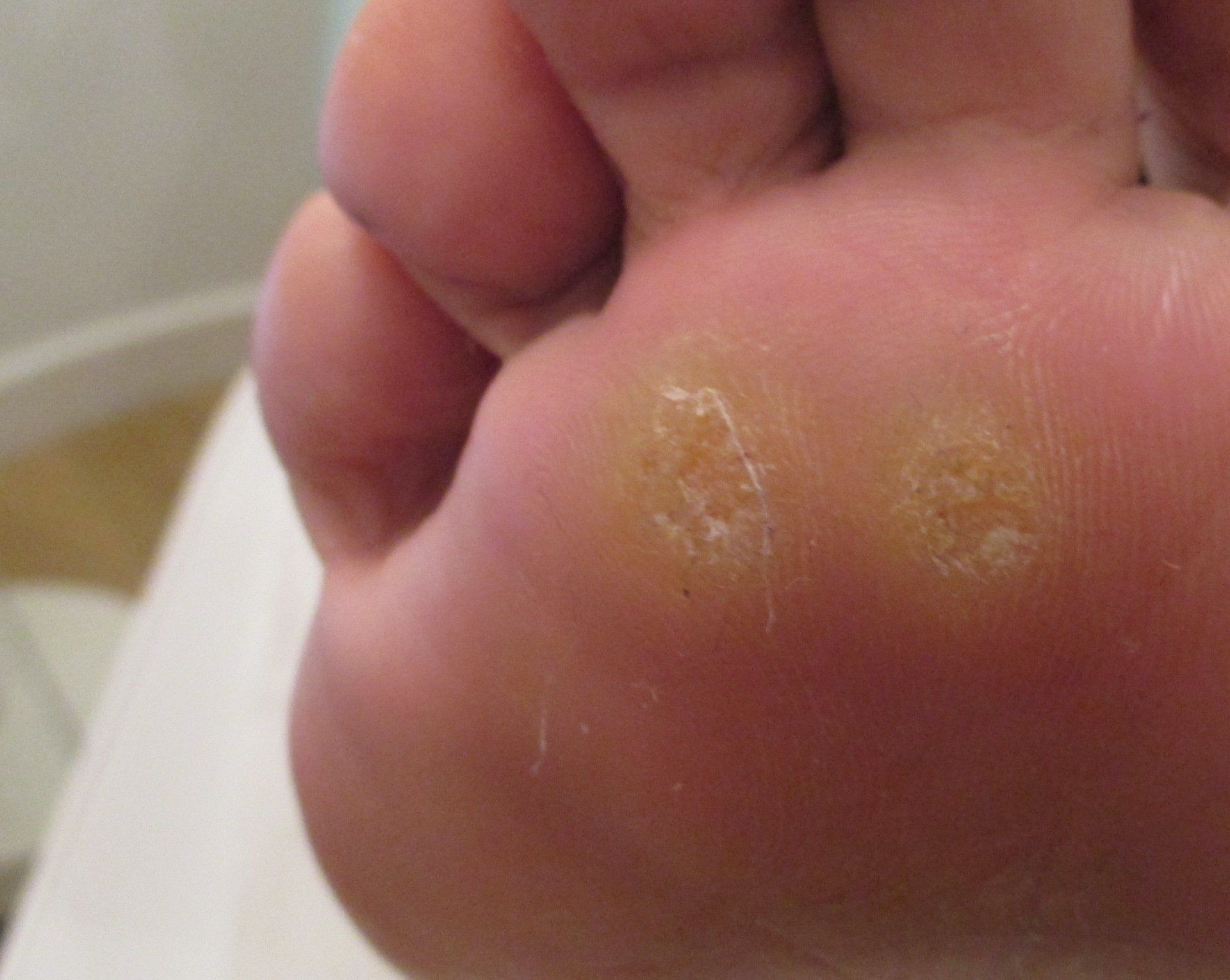 A close up of a person 's foot with a lot of white spots on it.