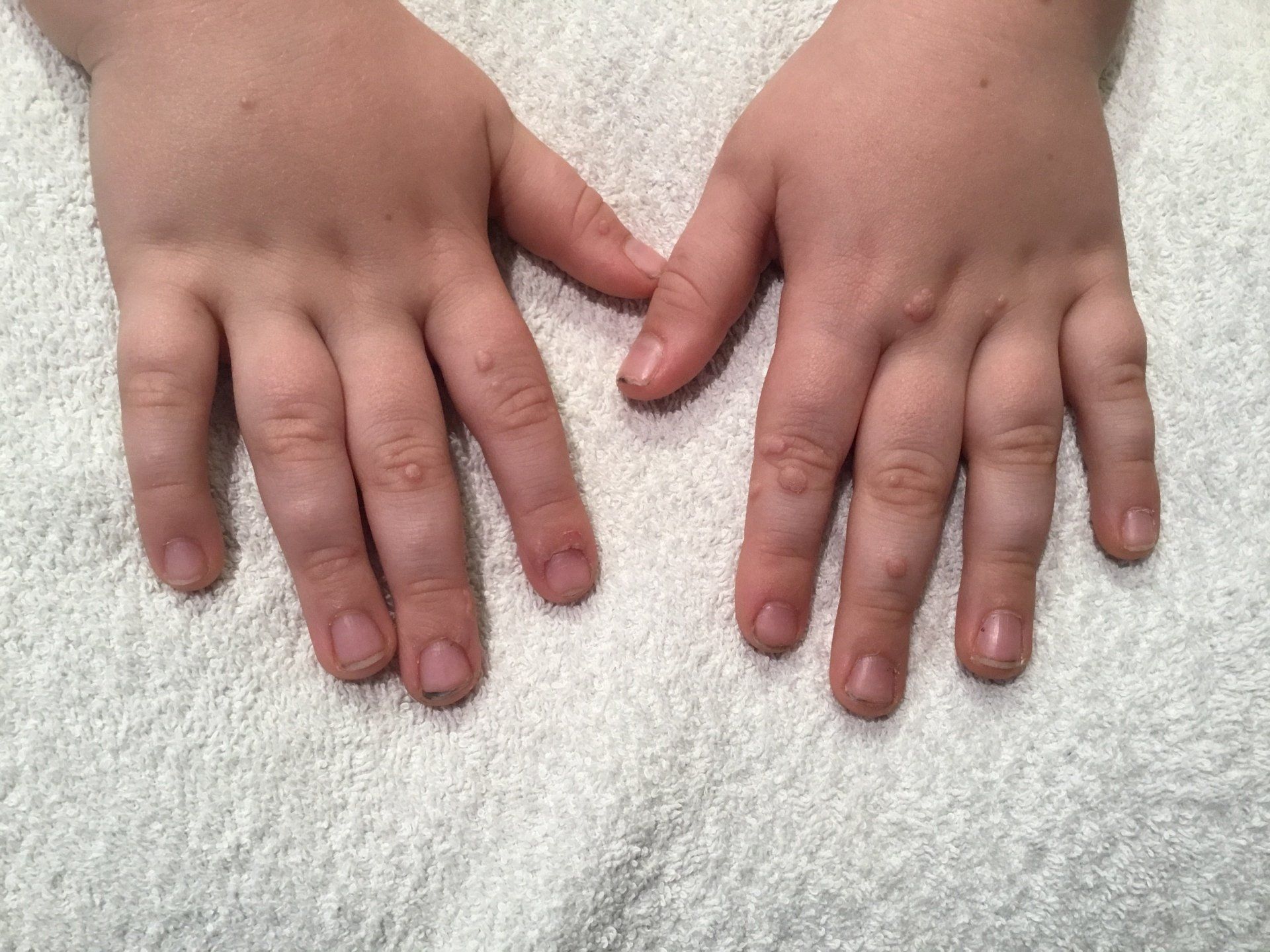 A close up of a child 's hands with warts prior to treatment at Pod Clinic