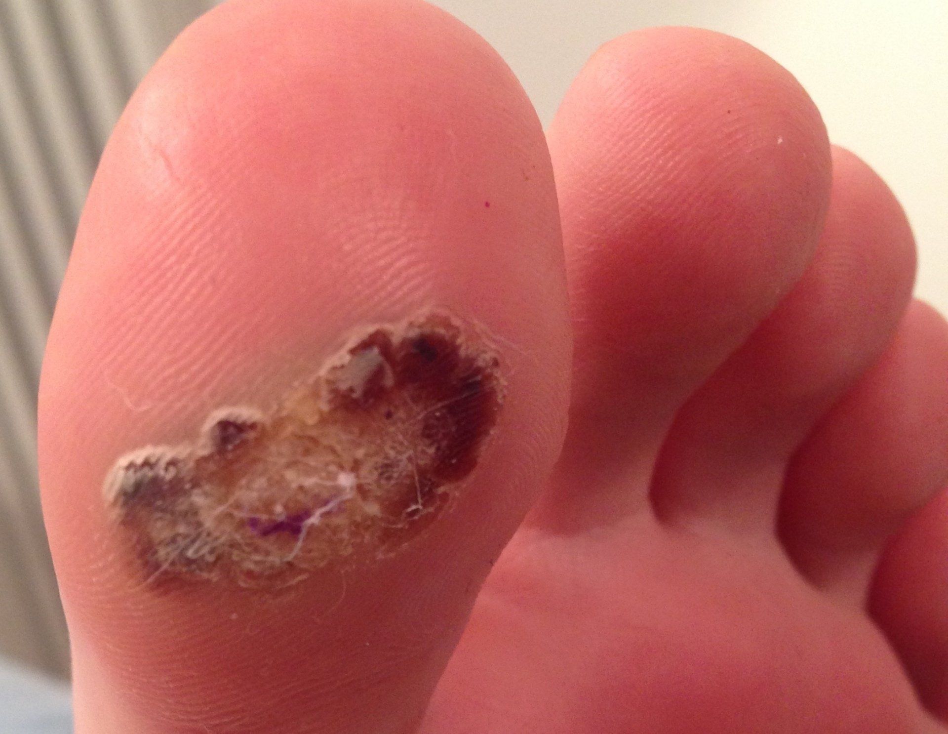 A large toe before treatment for warts