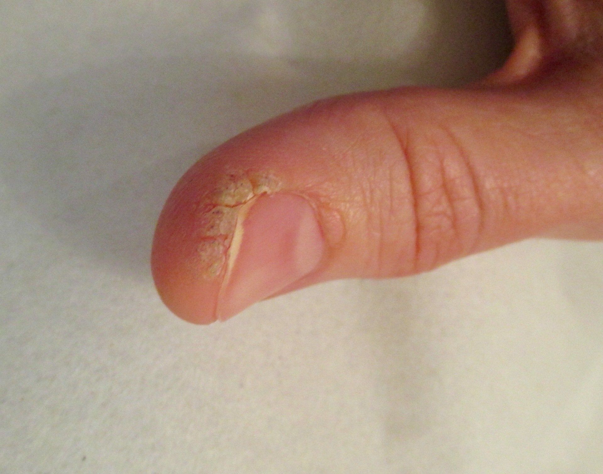 A thumb with a wart before treatment with Swift microwave at Pod Clinic