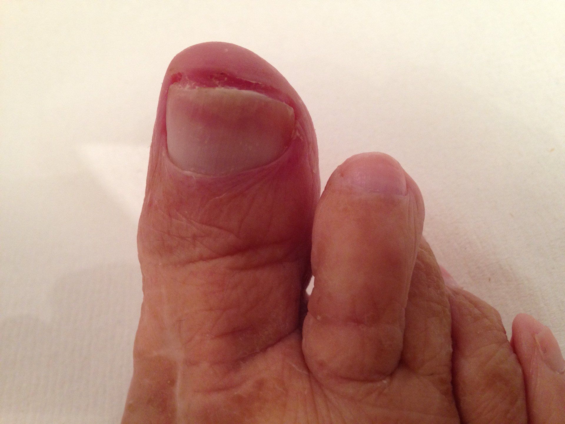 A close up of a person's toenail after laser treatment with Lunula
