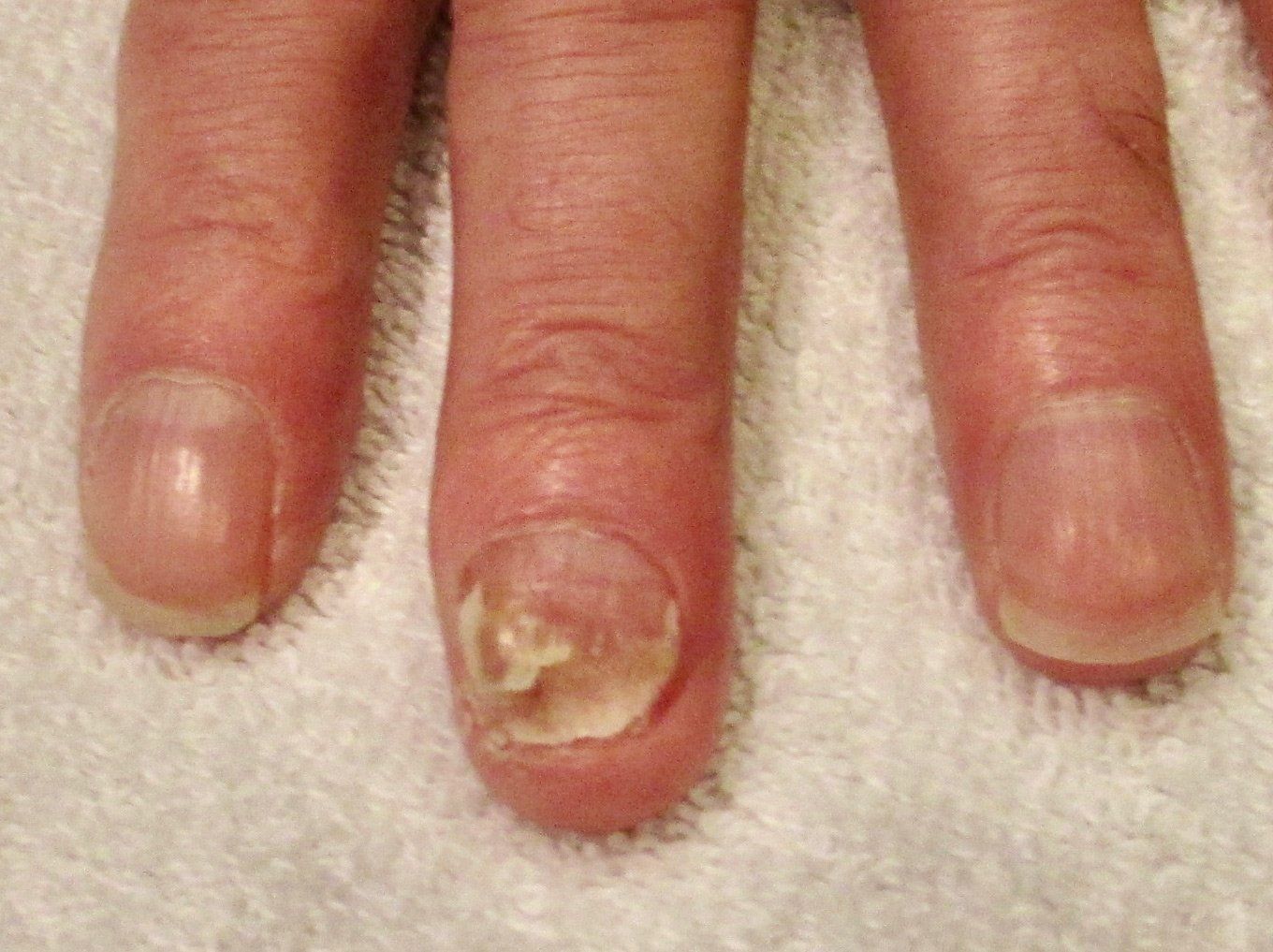 A close up of a person's nails  after treatment with Lunala laser