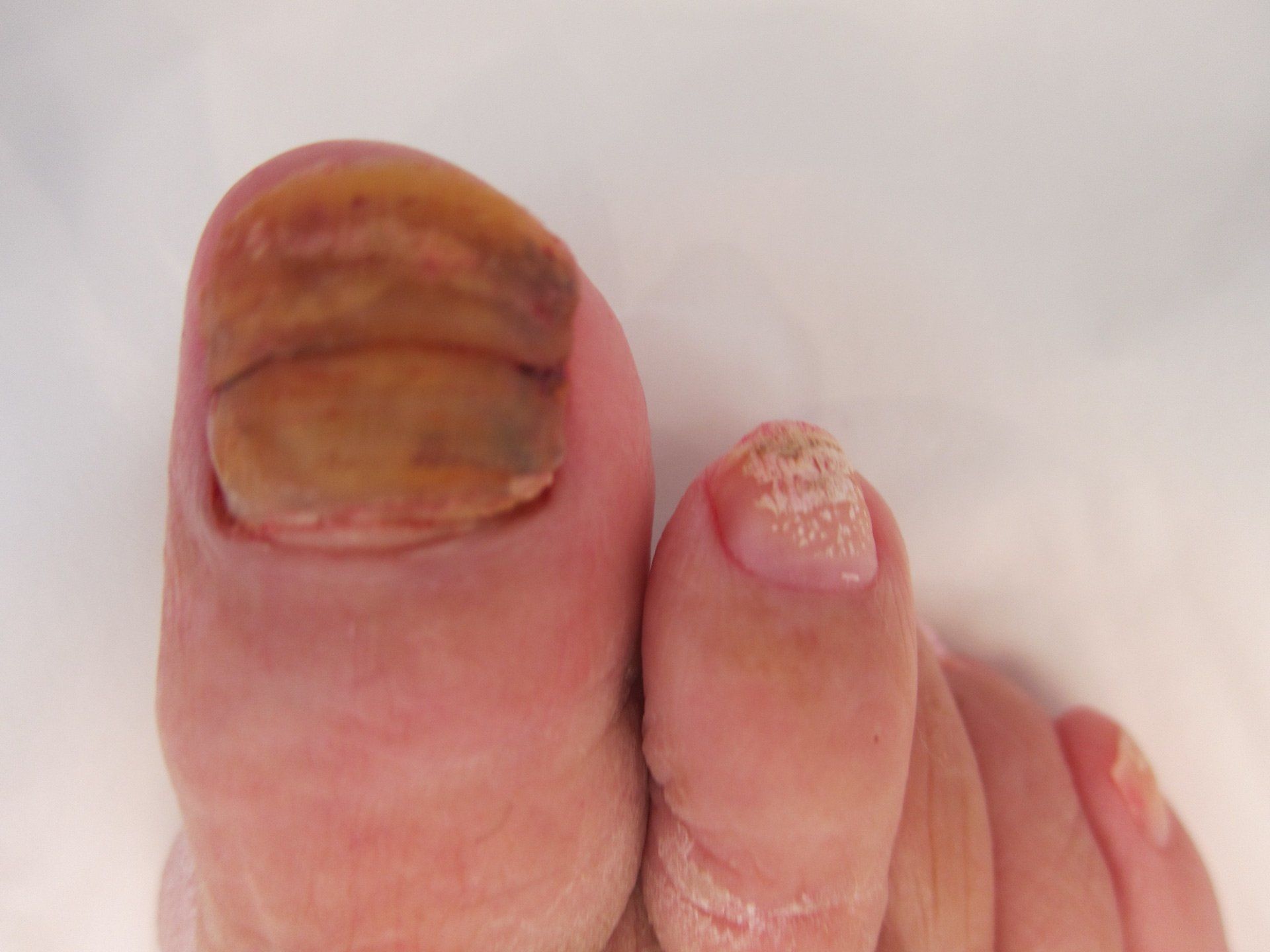 A close up of a person 's toenails  with fungal infection showing yellow/brown discolouration.
