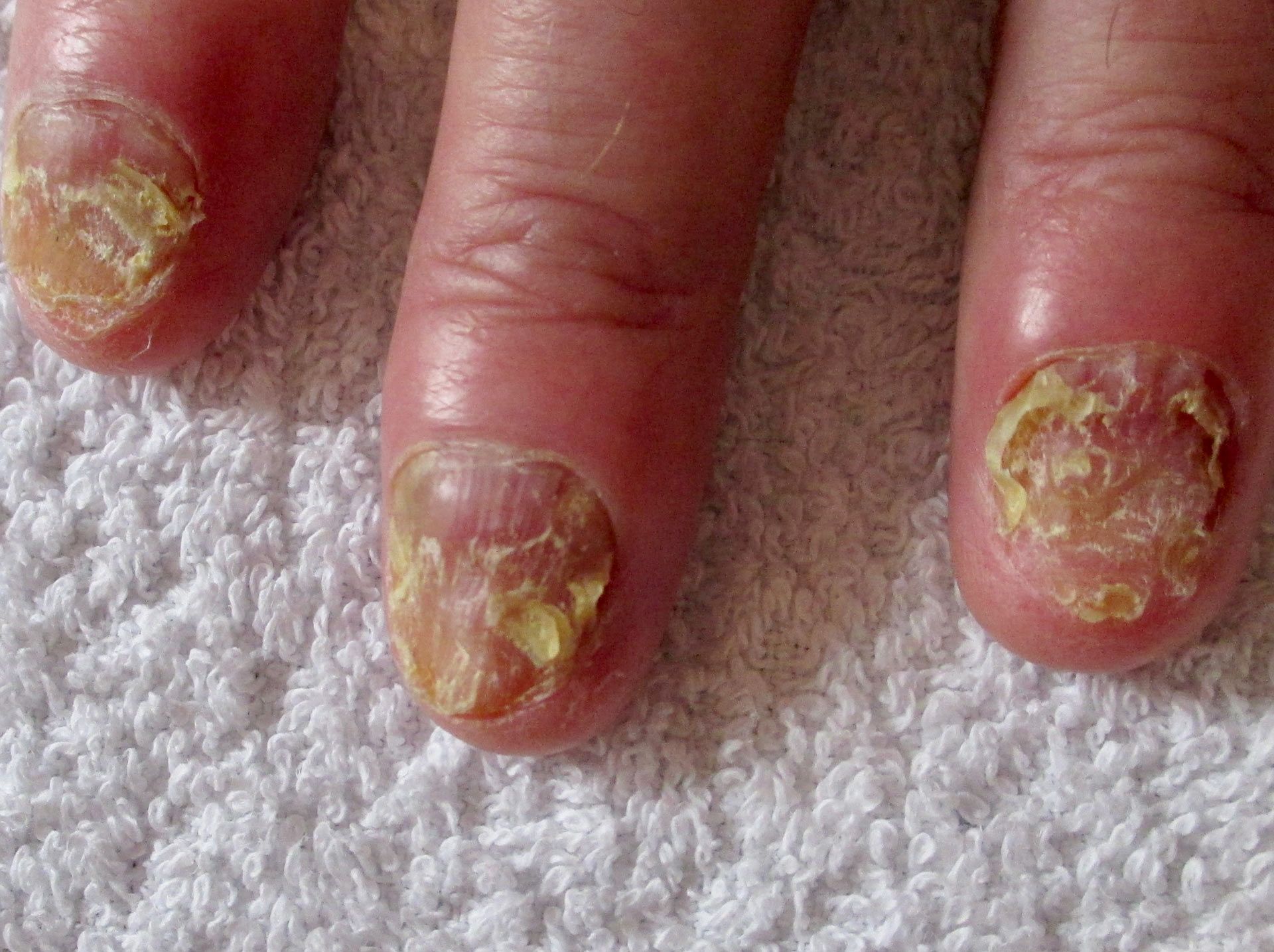 A close up of a person's fungal nails 