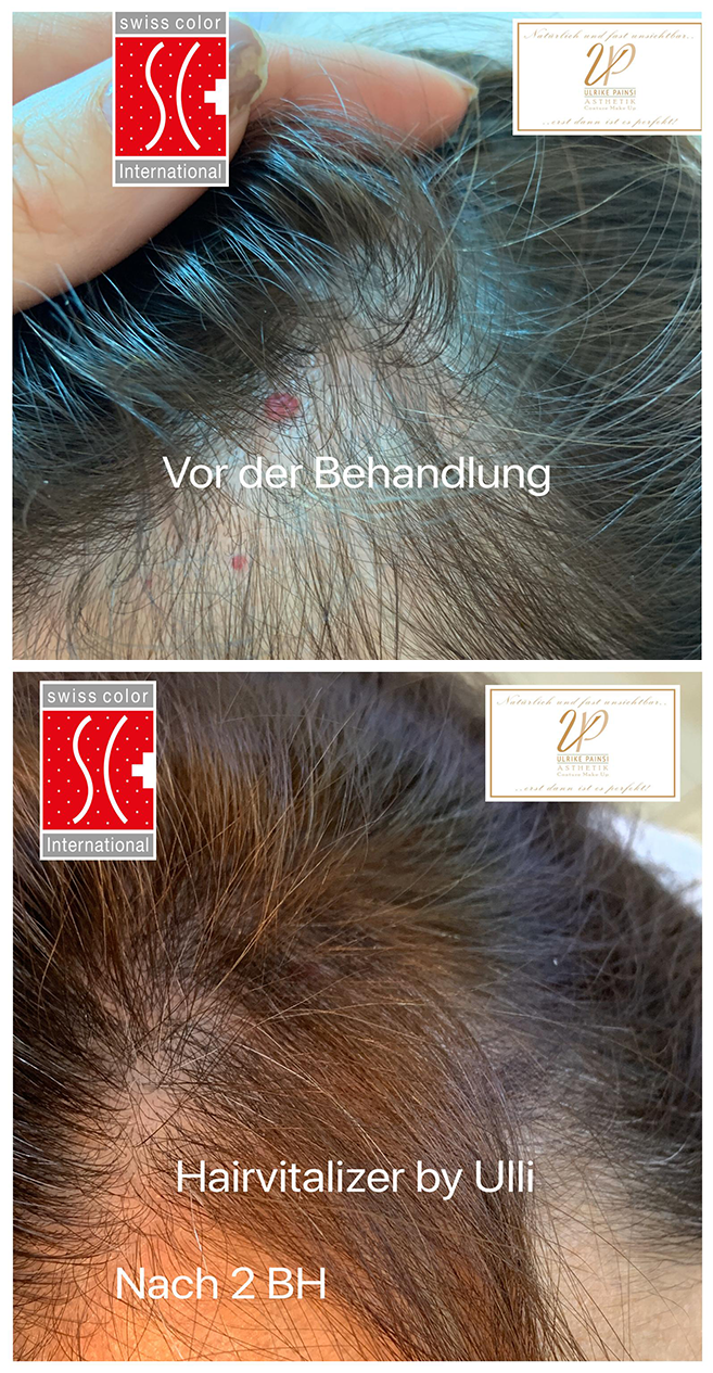 Vorher-nachher-Nahaufnahme der Kopfhaut, die die Reduzierung von Haarausfall durch ein Haarbehandlungsprodukt zeigt.