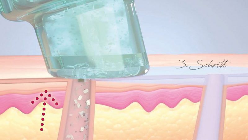 Eine Nahaufnahme einer Flasche mit Flüssigkeit, die auf die Haut einer Person aufgetragen wird.