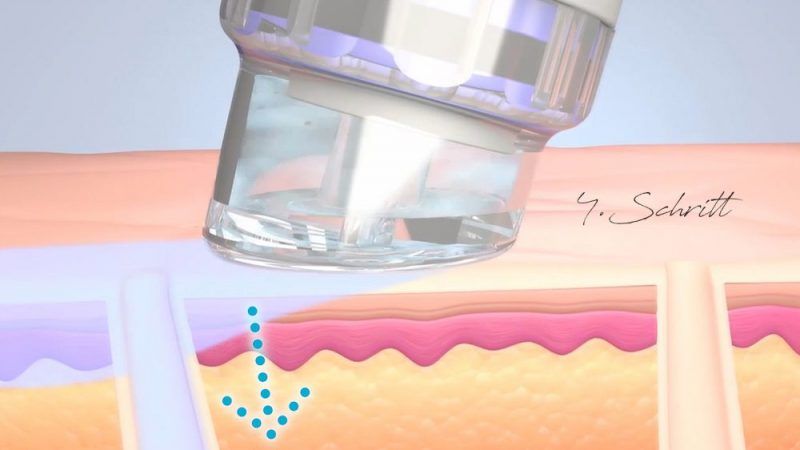 Ein computergeneriertes Bild einer Nadel, die in die Haut einer Person eingeführt wird.