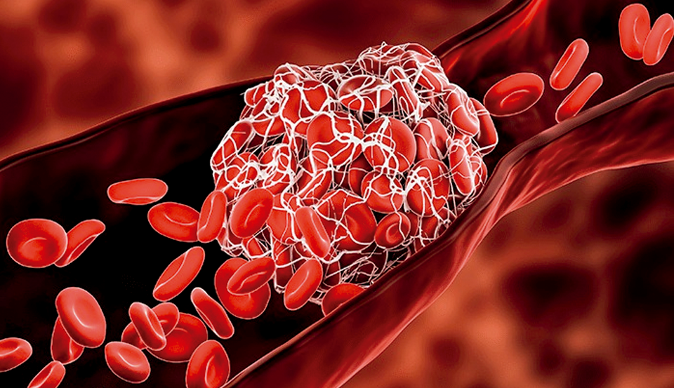 coagulo em vaso sanguíneo