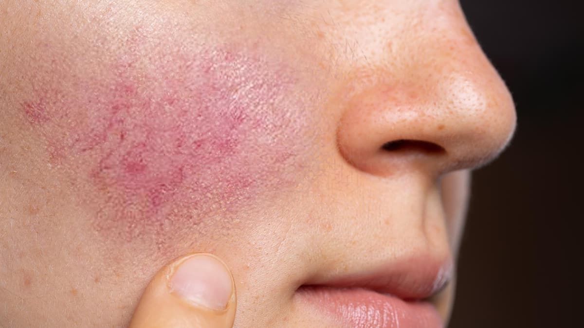 Facial Rejuvenation, Cornwall, Elapromode