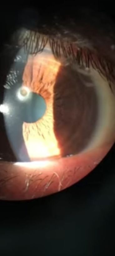 Refracción para estudios visuales con diagnóstico preciso
