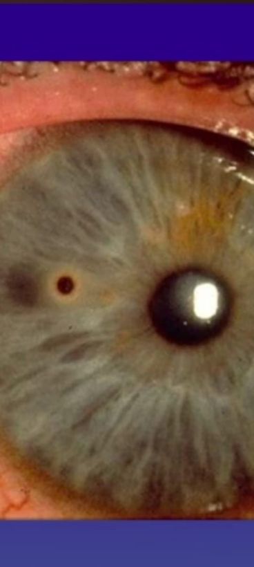 Rehabilitación visual para mejorar el desempeño ocular