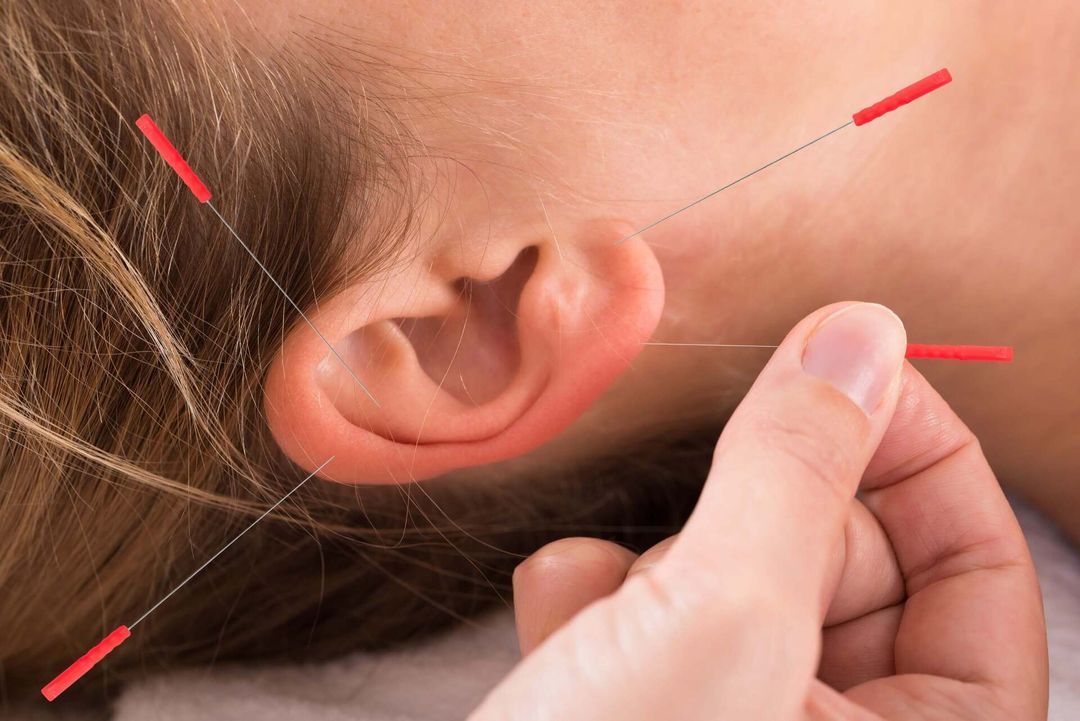 Agopuntura orecchio