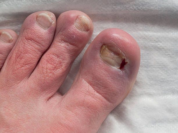 A close up of a person 's foot with a broken toenail.