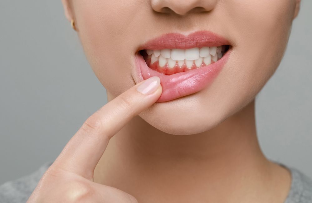 Woman Showing Irritated Gums From Dentures
