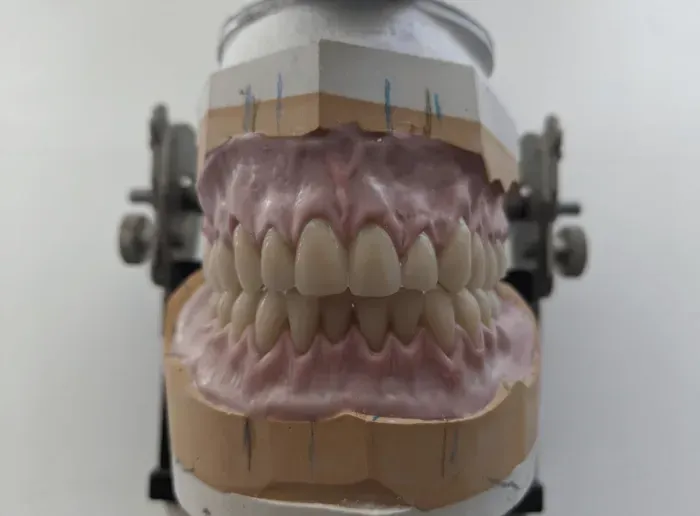 Dental Model of Upper and Lower Teeth — The Denture Care Group Sunshine Coast in Caloundra, QLD