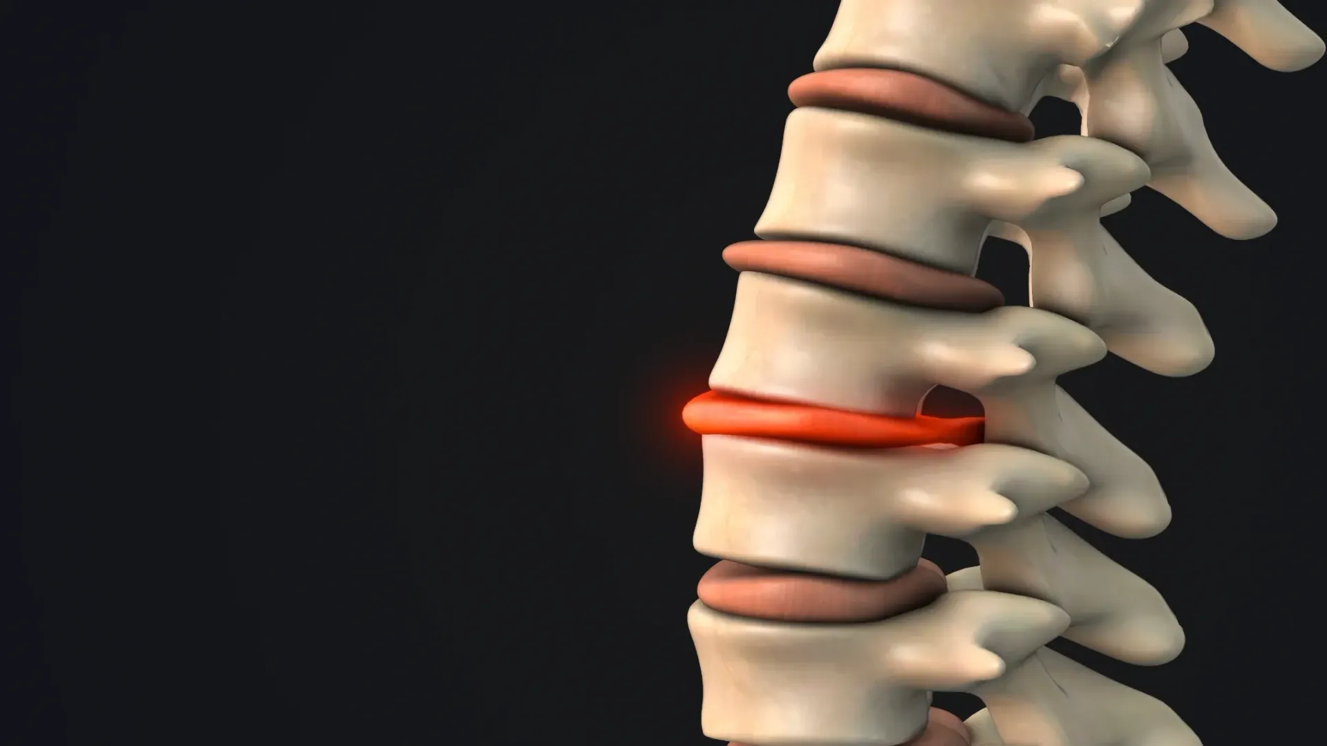 Spinal Column With a Highlighted, Red Herniated Disc — Spinal Decompression Sunshine Coast In Mooloolaba, QLD