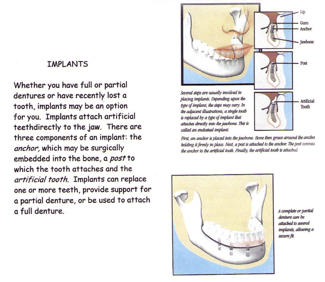 Dental implants in Beatrice, NE 