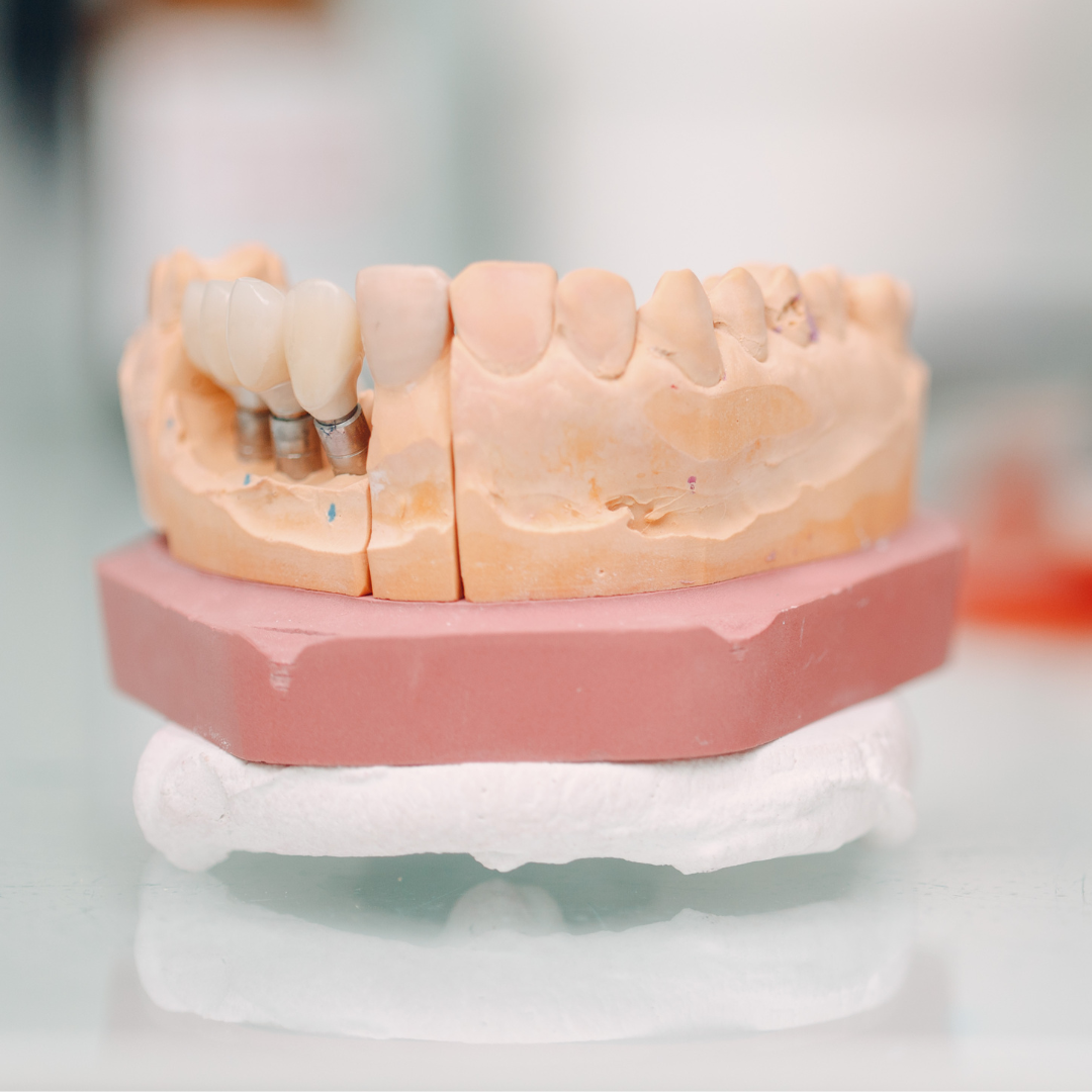 Image of multiple tooth implants dental