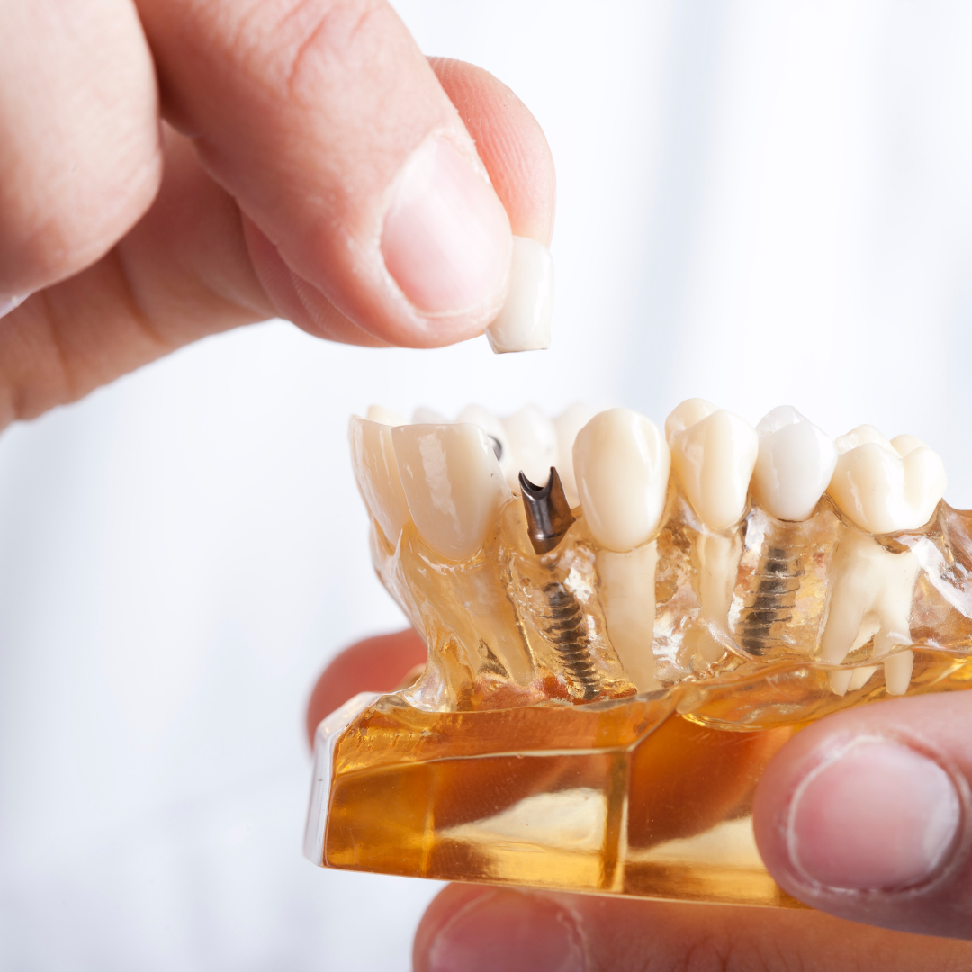 Image of single tooth replacement dental implant