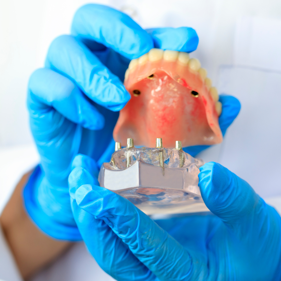 Image of implant retained denture full arch replacement teeth