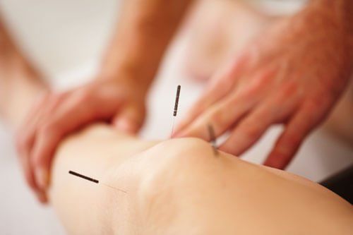 A person is getting dry needling on their knee.