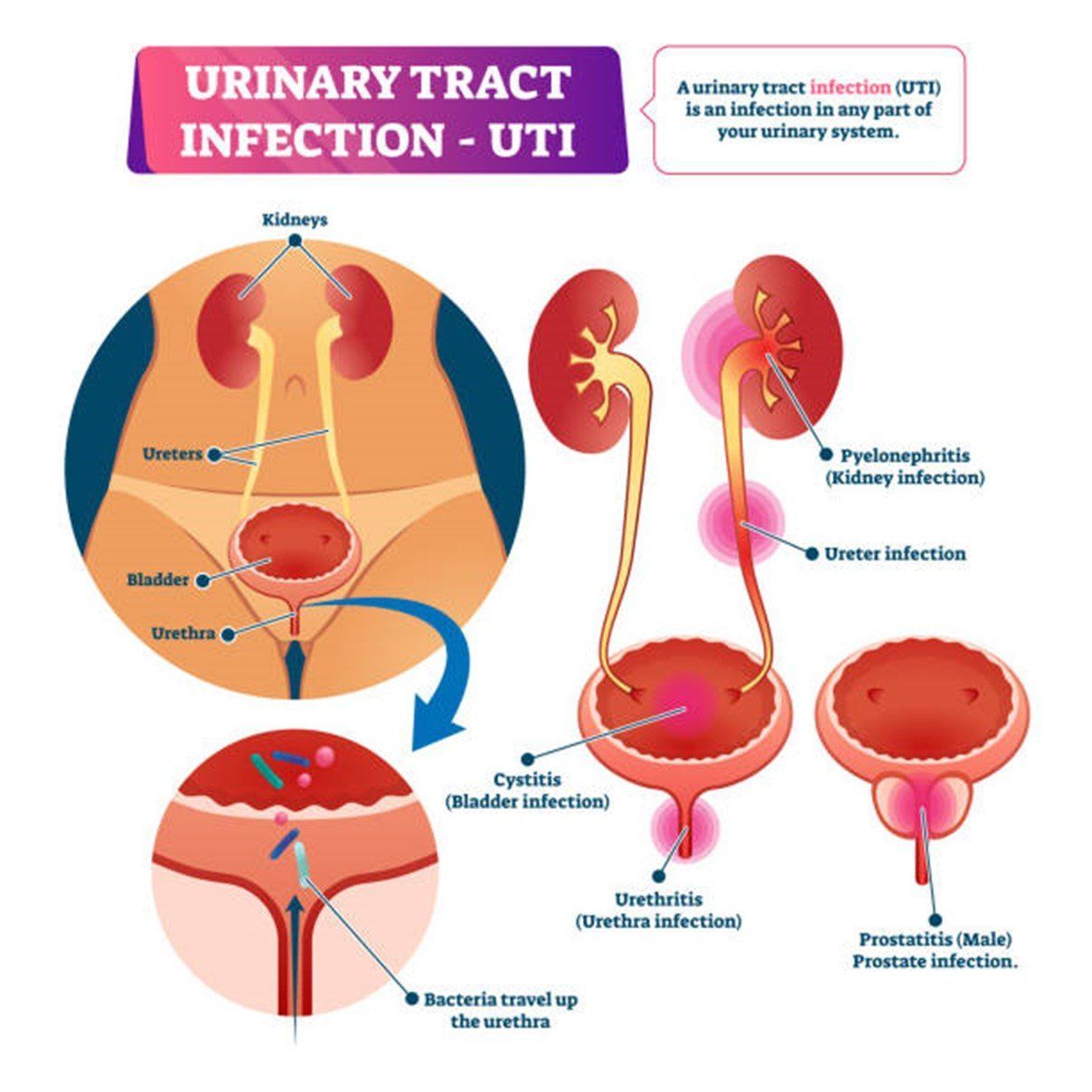 Urinary Tract Infections — Nashville, TN — Nashville Healthcare Center
