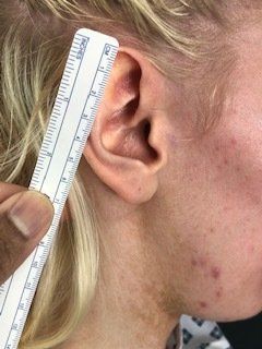 ENT Reddy Clinic - Ear Reduction Surgery