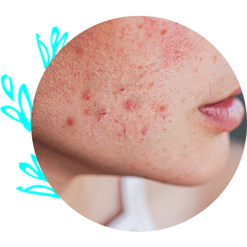 Acne on Woman's Face — Virginia Beach, VA — Dermatology Inc of Virginia Beach