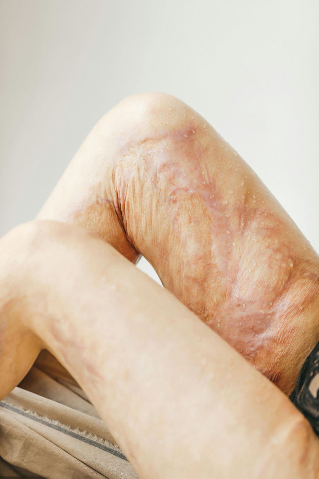 A close up of a person 's skin with freckles and a red spot.